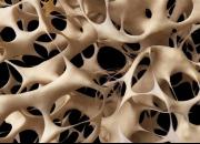 انواع پوکی استخوان +راه‌های درمان آن