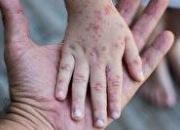 افزایش علائم پوستی در کودکان و سرخک
