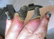 بیماری وحشتناکی که پوست و استخوانتان را سیاه می‌کند