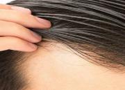 درمان خانگی چربی سر و از بین بردن چربی مو بدون شست‌وشو