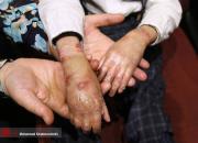 تولید ترمیم‌کننده زخم بیماران پروانه‌ای در ایران