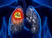 شدت آمفیزم با ریسک بالای ابتلا به سرطان ریه مرتبط است