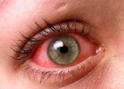 روش های درمان قرمزی چشم