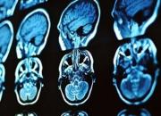 ارائه محصولی جدید برای تشخیص و درمان بیماری‌های مغزی