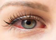درمان بیماری خشکی چشم با استفاده از یک فناوری جدید