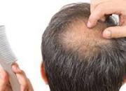 چرا مبتلایان به کرونا دچار ریزش مو می‌شوند؟