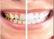 روش‌های خلاصی از شر جرم دندان