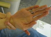 سندرمی که مبتلایان به آن انگشتان دستشان کِش می‌آید!