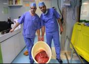 توده ۲۳کیلوگرمی از شکم یک بیمار در یزد خارج شد +عکس
