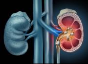 علایم و روش‌های درمان سنگ کلیه