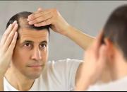 علل ریزش مو و روش درمان خانگی