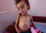 اعدام یمنی‌ها با سرطان و بیماری؛ دستور کار متجاوزان