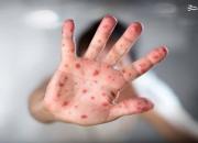 تهدید شیوع سرخک پس از عدم تزریق واکسن کرونا