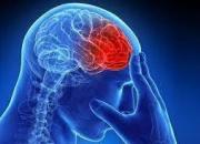 علائم اصلی سکته مغزی ناقص چیست؟