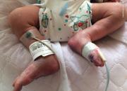 تولد نخستین نوزاد مبتلا به کرونای در مشهد